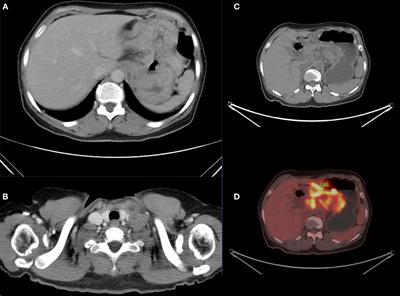 Complete remission in a patient with metastatic gastric cancer receiving tislelizumab combined with chemotherapy: a case report